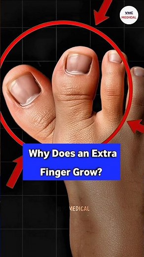 The concept of Polydactyly! By VMC Medical