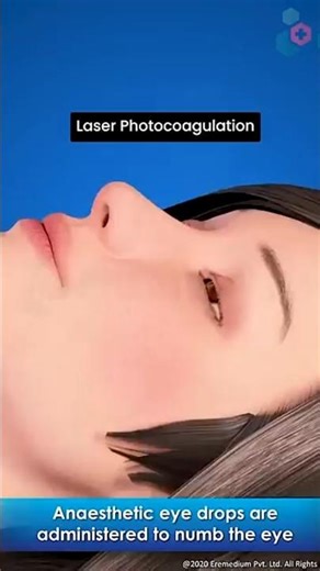 Laser Photocoagulation #3D animation video #medicalknowledge