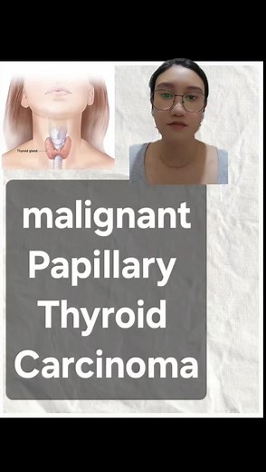 Insights before and after my full thyroidectomy #thyroidhealth #thyroidhealing #papillarythyroidcarcinoma #malignant #thyroidcancer #hypothyroidism #thyroidcancer