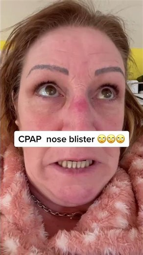 Continuous Positive Airway Pressure (CPAP) User with Blistered Nose#cpap #sleepapnea