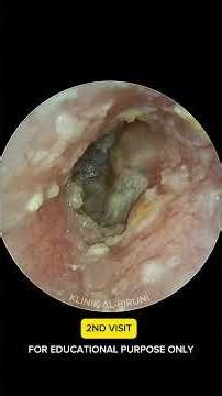 It Wasn't Earwax After All... #eardoctor #satisfying #earwaxremoval #ear #audiology