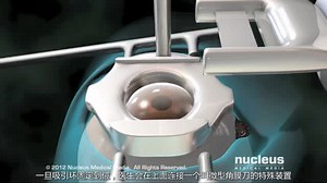 眼科手术3D动画合集