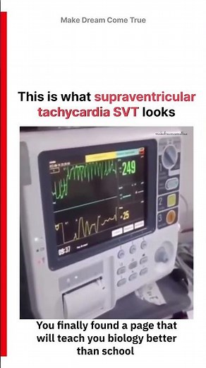 🫀This is what 📈 supraventricular tachycardia SVT⚡ looks 🔌 | MDCT