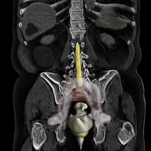 AI tools are used to automatically contour organs in radiation therapy planning to support clinicians in diagnosis and therapeutic decisions. https://bit.ly/37FRSgY | Siemens Healthineers