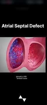 What is Atrial Septal Defect 🤔❓ And its Treatment 💊❓ Full video #atrialseptaldefect