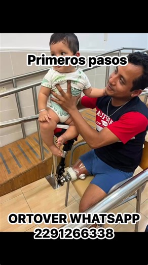 Prótesis con Soquet de succión de prueba, rodilla Total Knee con rotador y pie Proflex ST @OSSUR | Ramiro Cervantes