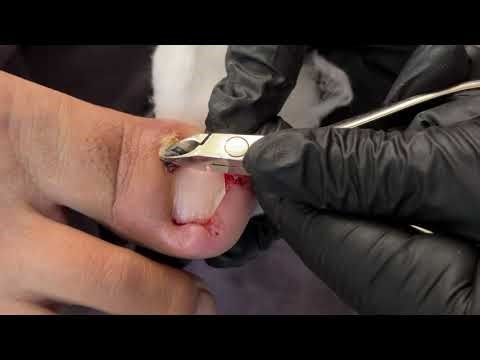 How to Cut and Clean an Ingrown Toenail: A Simple Guide