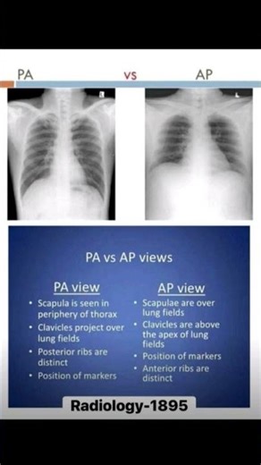 X-ray chest PA & AP
