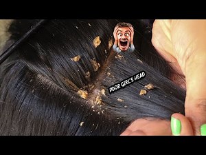 Dandruff Scratching!! #444