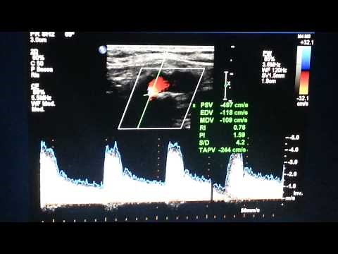 Carotid bruit: high grade stenosis