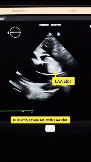 Rheumatic Heart Disease with Severe Tricuspid Regurgitation and Left Atrial Appendage (LAA) Clot 🫀