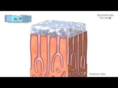 急性胃粘膜病変（AGML）／2分で分かる医療動画辞典 ミルメディカル