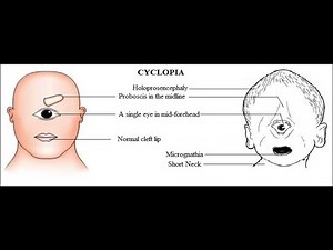 Holoprosencephaly / Cyclopia ; Embryological basis, causes, Features, characteristics