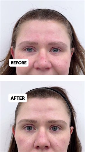 Botox Before and After: See the Difference