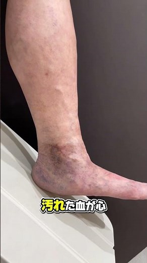 【下肢静脈瘤放置したら】#静脈瘤の佟先生 #大阪静脈瘤クリニック #下肢静脈瘤 #蜘蛛の巣状血管 #色素沈着 #潰瘍