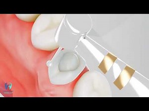 Dental Crowns Explained: Step-by-Step Animation of the Procedure