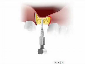 Bone Compression Kit - MIS Implants