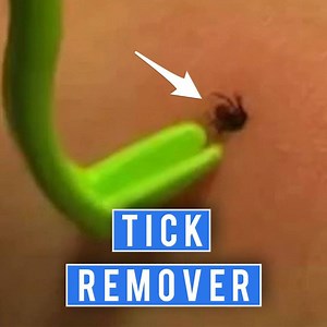 12K views · 28 reactions | This is the safest way to remove ticks from a body. | BEST Denver | Facebook