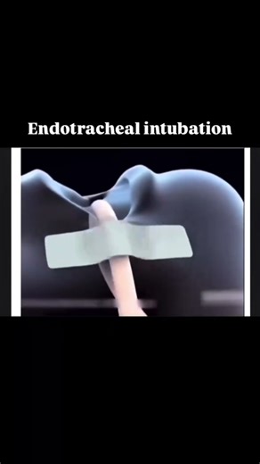 endotracheal intubation #trending #shorts #hospital #medicosstuff #ytshorts