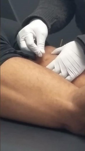 Dry Needling, Hamstring