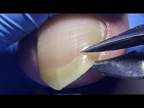 Complete trimming process for long and thick ingrown toenails!