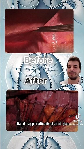 🛠️🪡Surgical Plication of the Diaphragm: A Look Inside 🩺