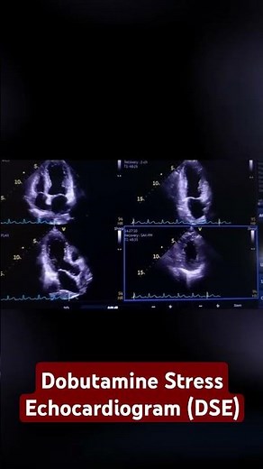 dobutamine stress echocardiogram (DSE)