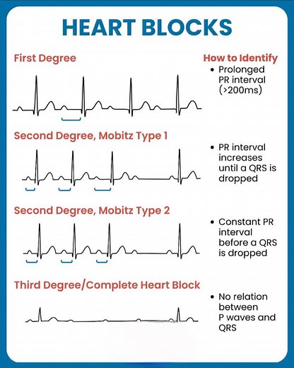 🔆 Atrioventricular (AV) Block – Impaired Conduction from Atria to Ventricles AV block refers to a delay or complete interruption of electrical conduction between the atria and ventricles through the AV node or His–Purkinje system. It may be transient or permanent, benign or life-threatening depending on the degree and location of the block. The clinical importance lies in the risk of bradycardia, syncope, or progression to cardiac arrest. ⸻ 📍 Cause / Pathophysiology • Functional or reversible 