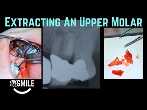 Upper Molar Extraction Secrets Revealed!