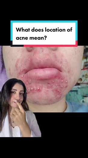 Understanding the Meaning of Acne Locations