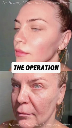 小傷口リフトで若返りを実現する方法