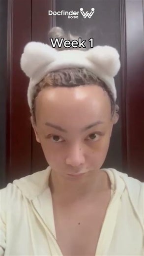 4 months after Facial Feminization Surgery Face Reveal (FFS Before and After)