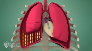 A chest drain empties air, blood or fluid through a tube that is inserted into the space surrounding your lungs. Fluid or air can build up after surgery or when there is inflammation, infection or a traumatic injury to the lungs. This animation simply explains what happens when a chest drain is needed. | St Vincent's Hospital Lung Health svhlunghealth.com.au
