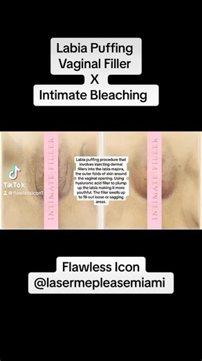 FLAWLESS ICON on Instagram: "Labia puff treatment is a non-invasive procedure that involves injecting dermal fillers into the labia majora, the outer folds of skin around the vaginal opening. The procedure can use hyaluronic acid-based fillers or the patient’s own fat to plump up the labia and make them appear more youthful. The fillers work by absorbing water from surrounding tissues, swelling up to fill out loose or sagging areas. Let’s plump it up 🔥🔥💧💧"