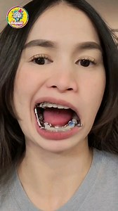 Bite corrector #instadaily #instagramindia #fbreels #instagood #followforfollowback #follow #followers #facebook #reelsinstagram #reels #knowitmalayalam | Knowit Malayalam