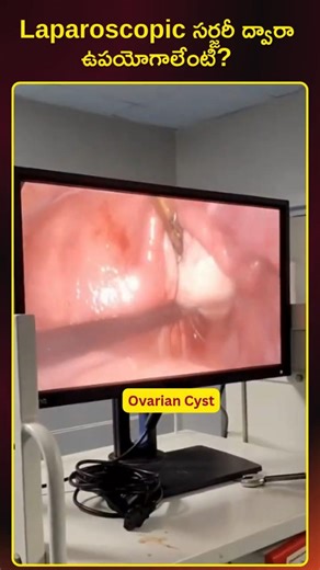 Laparoscopic Surgery Benefits for Ovarian Cyst & Appendicitis |Dr K.Sreelalitha HCC Hospital Mydukur