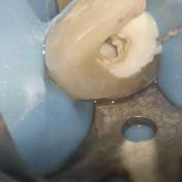 Calcium hydroxide placement in endodontics