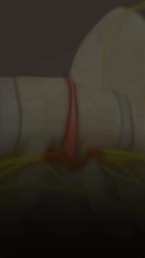 Dealing with persistent back and nerve pain from sciatica or herniated discs? At Alexandria Disc Center, we specialize in non-surgical spinal decompression therapy to provide instant relief for conditions like sciatica, bulging discs, herniated discs, and more. This advanced therapy gently stretches the spine, releasing pressure from your nerves and offering rapid relief so you can get back to living pain-free. We’ve helped hundreds of patients feel better faster—and we’re excited to help even m