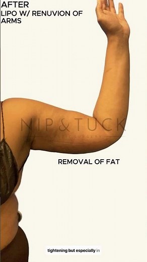 Transform Your Arms: Stunning Arm Lift Before & After Reveals