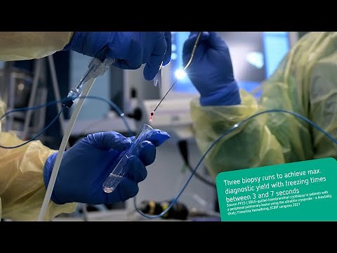 Mini-probe cryobiopsy with fluoroscopy and rEBUS - Airway management with flexible endotracheal tube