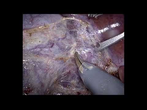 Robotic cholecystectomy scissor dissection