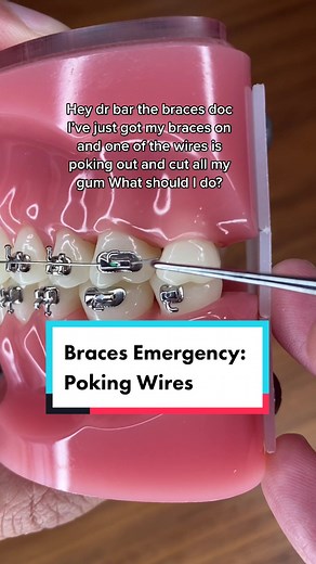 Braces Emergency: Poking Wires Solutions
