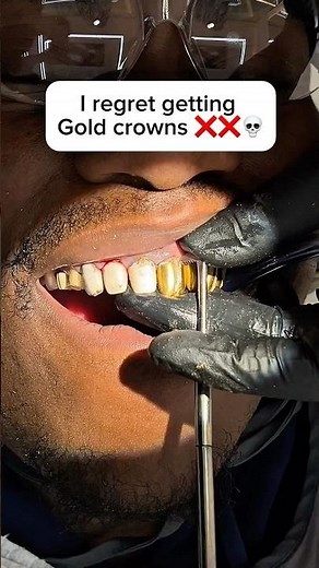 Gold caps vs porcelain crowns #goldcrown #porcelainveneers #topsmiles