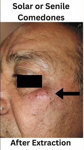 “Solar / Senile Comedones ☀️👵 | The Sun's Silent Skin Damage” Dr.Vipul Pareek MD Skinfollics Clinic