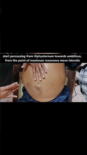shifting dullness in ascites #ascites #fluid #abdomen #liver #cirrhosis #medicine #doctor #mbbs