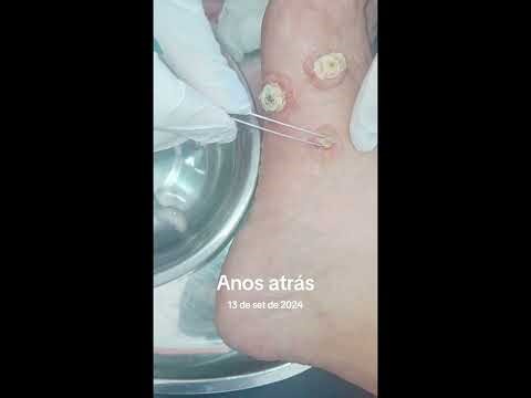 Botfly Maggot Removal #spa #doctor #satisfying #pimple #removal
