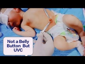 Umbilical Vein Exchange Transfusion in NICU.