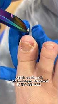 Why Did This Nail Lift Off the Nail Bed? 👀 | Onycholysis Explained #podiatry #toenails #onycholysis