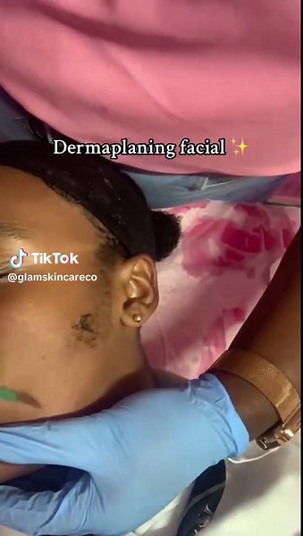 Dermaplaning is a non-invasive exfoliating treatment that uses a surgical scalpel to gently scrape off the top layer of dead skin cells and vellus hair. How it works: A trained professional glides the scalpel at a 45-degree angle across the skin's surface, removing dead skin and fine hairs. Benefits: Exfoliation: Dermaplaning removes dead skin cells, revealing brighter and smoother skin. Hair removal: It removes vellus hair, also known as