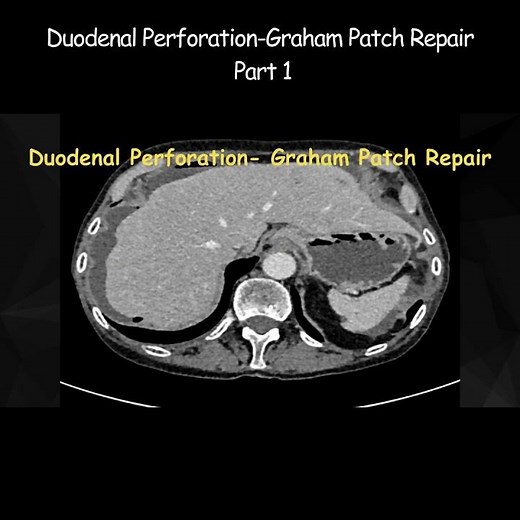 Duodenal Perforation Graham Patch Repair Part 1 #infertility #pepticulcer #radiology #radiologist